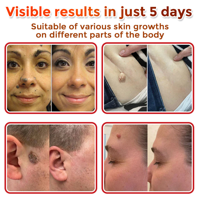 🌍🔥Made in USA ✅GFOUK® MicroNeedle Botanic Skin Tag Removal Patch