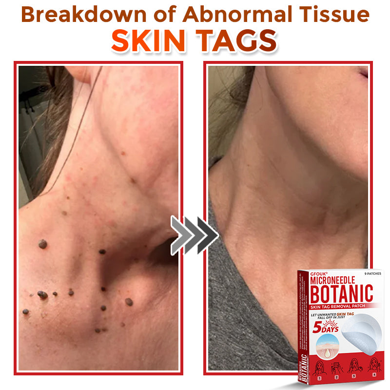 🌍🔥Made in USA ✅GFOUK® MicroNeedle Botanic Skin Tag Removal Patch