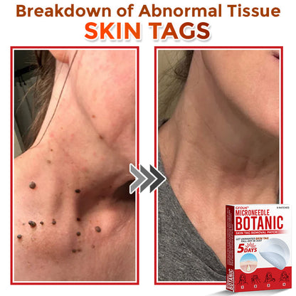 🌍🔥Made in USA ✅GFOUK® MicroNeedle Botanic Skin Tag Removal Patch