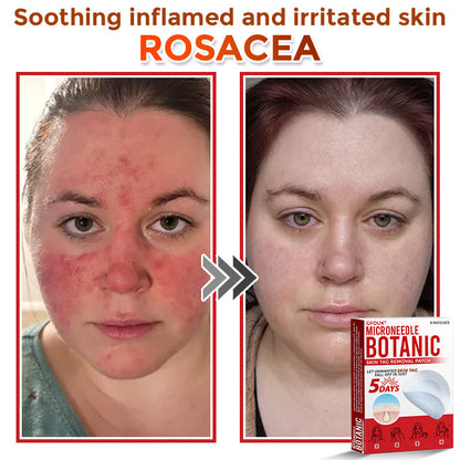 🌍🔥Made in USA ✅GFOUK® MicroNeedle Botanic Skin Tag Removal Patch