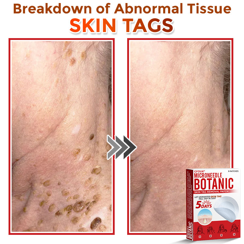 🌍🔥Made in USA ✅GFOUK® MicroNeedle Botanic Skin Tag Removal Patch