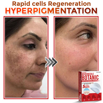 🌍🔥Made in USA ✅GFOUK® MicroNeedle Botanic Skin Tag Removal Patch