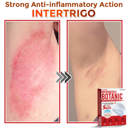🌍🔥Made in USA ✅GFOUK® MicroNeedle Botanic Skin Tag Removal Patch