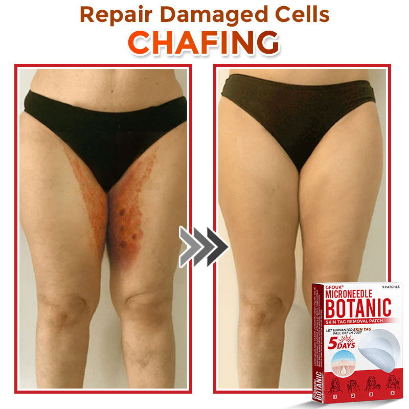🌍🔥Made in USA ✅GFOUK® MicroNeedle Botanic Skin Tag Removal Patch