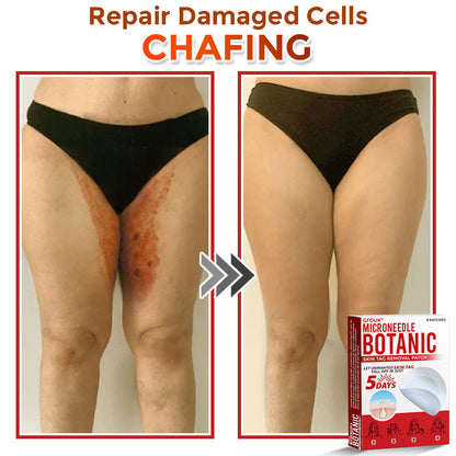 🌍🔥Made in USA ✅GFOUK® MicroNeedle Botanic Skin Tag Removal Patch