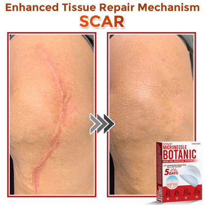 🌍🔥Made in USA ✅GFOUK® MicroNeedle Botanic Skin Tag Removal Patch